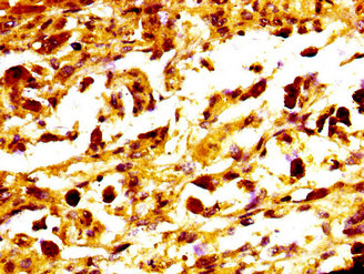 MC1R Antibody - Immunohistochemistry image at a dilution of 1:400 and staining in paraffin-embedded human melanoma cancer performed on a Leica BondTM system. After dewaxing and hydration, antigen retrieval was mediated by high pressure in a citrate buffer (pH 6.0) . Section was blocked with 10% normal goat serum 30min at RT. Then primary antibody (1% BSA) was incubated at 4 °C overnight. The primary is detected by a biotinylated secondary antibody and visualized using an HRP conjugated SP system.