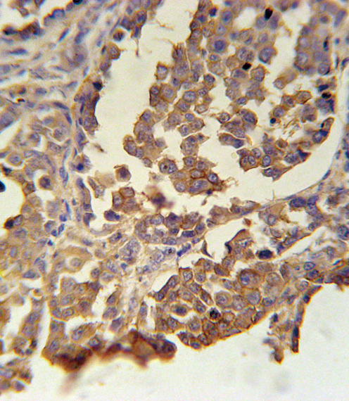 MC2R / ACTHR / ACTH Receptor Antibody - MC2R Antibody immunohistochemistry of formalin-fixed and paraffin-embedded human skin carcinoma followed by peroxidase-conjugated secondary antibody and DAB staining.