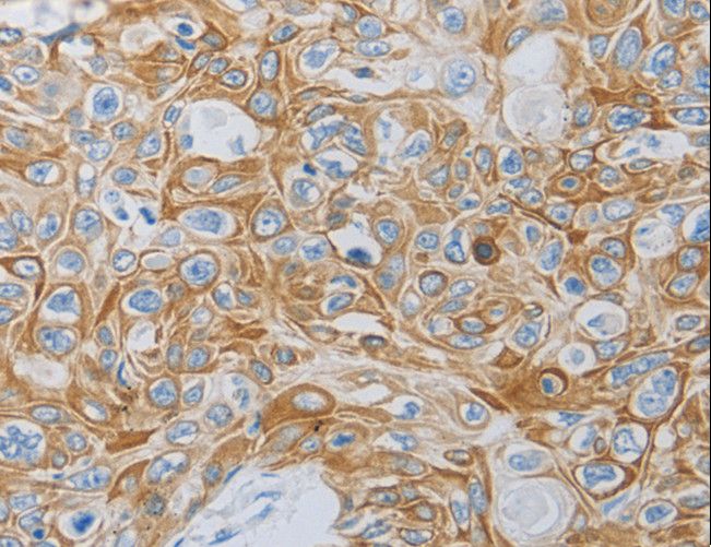 MC5R / MC5 Receptor Antibody - Immunohistochemistry of paraffin-embedded Human esophagus cancer using MC5R Polyclonal Antibody at dilution of 1:60.