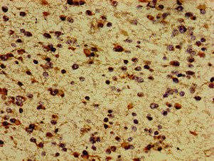 MC5R / MC5 Receptor Antibody - Immunohistochemistry image of paraffin-embedded human glioma cancer at a dilution of 1:100