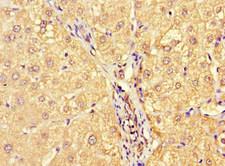 MCA32 Antibody - Immunohistochemistry of paraffin-embedded human liver cancer at dilution 1:100