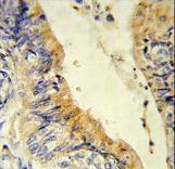 MCAD / ACADM Antibody - Formalin-fixed and paraffin-embedded human colon carcinoma reacted with ACADM Antibody , which was peroxidase-conjugated to the secondary antibody, followed by DAB staining. This data demonstrates the use of this antibody for immunohistochemistry; clinical relevance has not been evaluated.