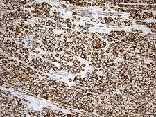 MCAD / ACADM Antibody - Immunohistochemical staining of paraffin-embedded Adenocarcinoma of Human breast tissue tissue using anti-ACADM mouse monoclonal antibody. (Heat-induced epitope retrieval by 1mM EDTA in 10mM Tris buffer. (pH8.5) at 120°C for 3 min. (1:500)