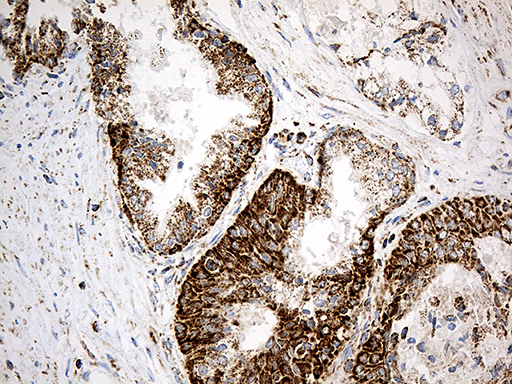 MCAD / ACADM Antibody - Immunohistochemical staining of paraffin-embedded Carcinoma of Human prostate tissue using anti-ACADM mouse monoclonal antibody. (Heat-induced epitope retrieval by 1mM EDTA in 10mM Tris buffer. (pH8.5) at 120°C for 3 min. (1:500)