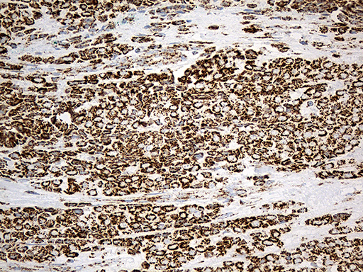 MCAD / ACADM Antibody - Immunohistochemical staining of paraffin-embedded Adenocarcinoma of Human breast tissue tissue using anti-ACADM mouse monoclonal antibody. (Heat-induced epitope retrieval by 1mM EDTA in 10mM Tris buffer. (pH8.5) at 120°C for 3 min. (1:500)