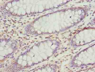 MCAD / ACADM Antibody - Immunohistochemistry of paraffin-embedded human colon cancer using antibody at dilution of 1:100.