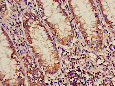 MCAD / ACADM Antibody - Immunohistochemistry of paraffin-embedded human colon cancer using ACADM Antibody at dilution of 1:100