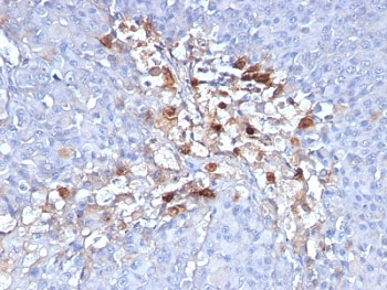 MCAM / CD146 Antibody - Formalin-fixed, paraffin-embedded human melanoma stained with CD146 antibody (C146/634).  This image was taken for the unmodified form of this product. Other forms have not been tested.