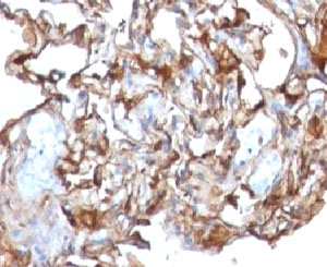 MCAM / CD146 Antibody - IHC testing of human melanoma and CD146 antibody.  This image was taken for the unmodified form of this product. Other forms have not been tested.