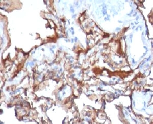 MCAM / CD146 Antibody - Formalin-fixed, paraffin-embedded human melanoma stained with MCAM antibody (MCAM/1101).  This image was taken for the unmodified form of this product. Other forms have not been tested.