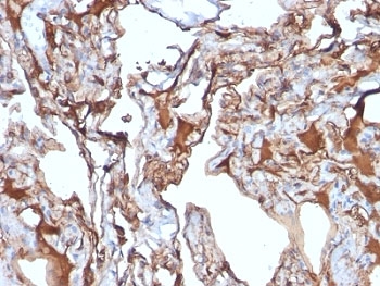 MCAM / CD146 Antibody - Formalin-fixed, paraffin-embedded human melanoma stained with CD146 antibody (MUC18/1130).  This image was taken for the unmodified form of this product. Other forms have not been tested.