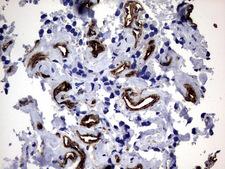 MCAM / CD146 Antibody - IHC of paraffin-embedded Adenocarcinoma of Human breast tissue using anti-MCAM mouse monoclonal antibody. (Heat-induced epitope retrieval by 1 mM EDTA in 10mM Tris, pH9.0, 120°C for 3min).