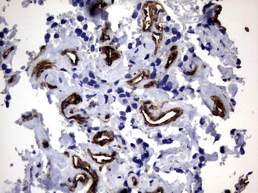 MCAM / CD146 Antibody - IHC of paraffin-embedded Adenocarcinoma of Human breast tissue using anti-MCAM mouse monoclonal antibody. (Heat-induced epitope retrieval by 1 mM EDTA in 10mM Tris, pH9.0, 120°C for 3min).