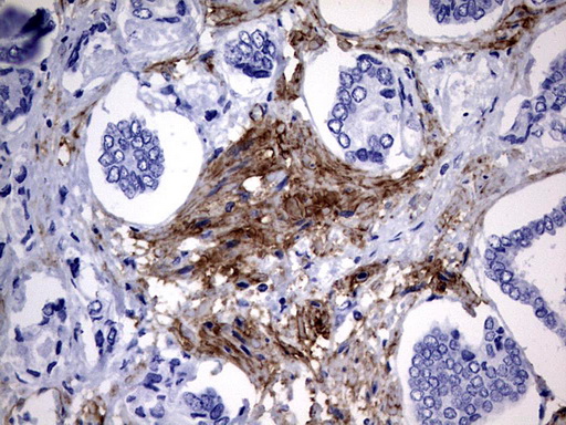 MCAM / CD146 Antibody - IHC of paraffin-embedded Human prostate tissue using anti-MCAM mouse monoclonal antibody. (Heat-induced epitope retrieval by 1 mM EDTA in 10mM Tris, pH9.0, 120°C for 3min).