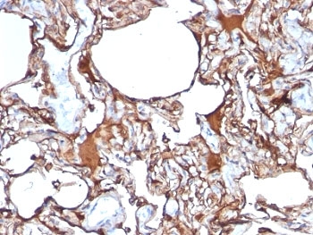 MCAM / CD146 Antibody - Formalin-fixed, paraffin-embedded human melanoma stained with anti-CD146 antibody (SPM620).  This image was taken for the unmodified form of this product. Other forms have not been tested.