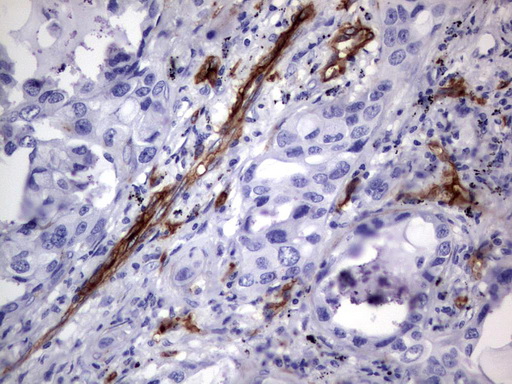 MCAM / CD146 Antibody - Immunohistochemical staining of paraffin-embedded Carcinoma of Human lung tissue using anti-MCAM mouse monoclonal antibody.  heat-induced epitope retrieval by 1 mM EDTA in 10mM Tris, pH9.0, 120C for 3min)