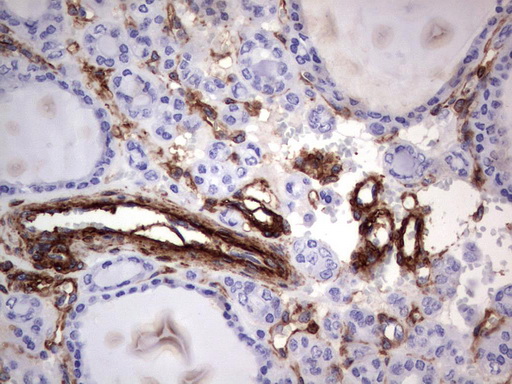 MCAM / CD146 Antibody - Immunohistochemical staining of paraffin-embedded Carcinoma of Human thyroid tissue using anti-MCAM mouse monoclonal antibody.  heat-induced epitope retrieval by 1 mM EDTA in 10mM Tris, pH9.0, 120C for 3min)