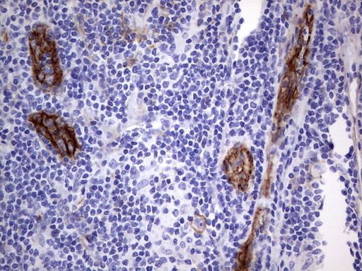 MCAM / CD146 Antibody - Immunohistochemical staining of paraffin-embedded Human lymphoma tissue using anti-MCAM mouse monoclonal antibody.  heat-induced epitope retrieval by 1 mM EDTA in 10mM Tris, pH9.0, 120C for 3min)
