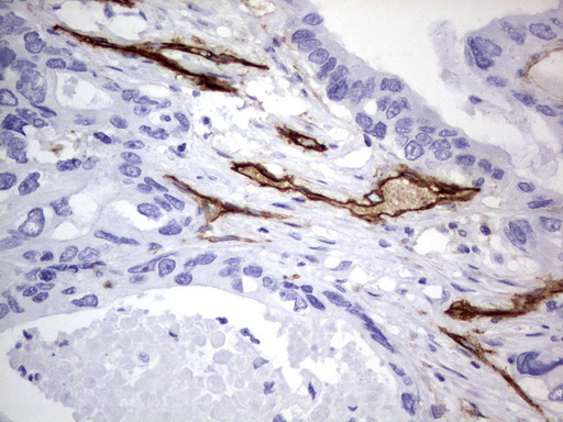 MCAM / CD146 Antibody - Immunohistochemical staining of paraffin-embedded Adenocarcinoma of Human colon tissue using anti-MCAM mouse monoclonal antibody.  heat-induced epitope retrieval by 1 mM EDTA in 10mM Tris, pH9.0, 120C for 3min)