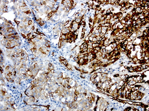 MCAM / CD146 Antibody - Immunohistochemical staining of paraffin-embedded human melanoma using anti- CD146. (MCAM) clone UMAB155 mouse monoclonal antibody at 1:200 dilution of 1.0 mg/mL using Polink2 Broad HRP DAB for detection.requires HIER with with Accel 3in1 EDTA solution ph8.7 at 110C for 3 min using pressure chamber/cooker. The tumor cells shows strong membraneous and cytoplasmic staining.