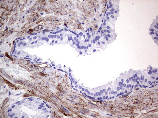MCAM / CD146 Antibody - Immunohistochemical staining of paraffin-embedded Carcinoma of Human prostate tissue using anti-MCAM mouse monoclonal antibody.  heat-induced epitope retrieval by 1 mM EDTA in 10mM Tris, pH9.0, 120C for 3min)