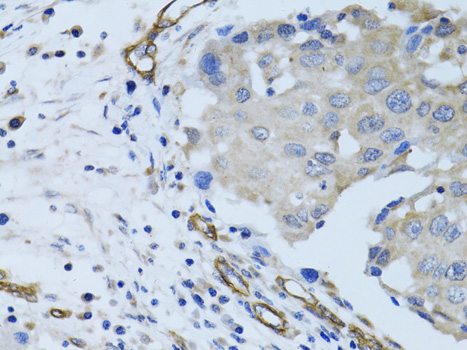 MCAM / CD146 Antibody - Immunohistochemistry of paraffin-embedded human breast cancer using MCAM antibody at dilution of 1:100 (40x lens).