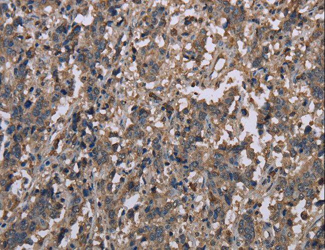 MCC Antibody - Immunohistochemistry of paraffin-embedded Human gastric cancer using MCC Polyclonal Antibody at dilution of 1:30.