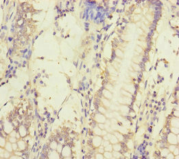 MCCC1 Antibody - Immunohistochemistry of paraffin-embedded human colon cancer at dilution of 1:100