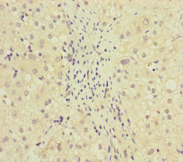 MCCC1 Antibody - Immunohistochemistry of paraffin-embedded human liver cancer at dilution of 1:100