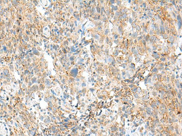 MCCC1 Antibody - Immunohistochemistry of paraffin-embedded Human cervical cancer tissue  using MCCC1 Polyclonal Antibody at dilution of 1:45(×200)
