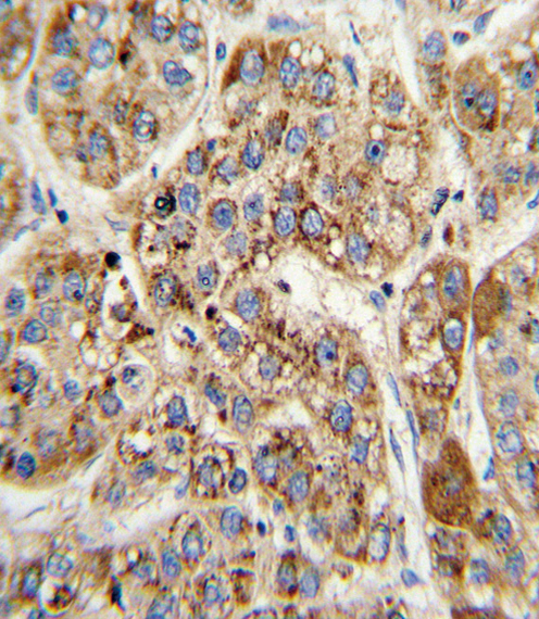 MCCC2 / MCCB Antibody - Formalin-fixed and paraffin-embedded human hepatocarcinoma with MCCC2 Antibody , which was peroxidase-conjugated to the secondary antibody, followed by DAB staining. This data demonstrates the use of this antibody for immunohistochemistry; clinical relevance has not been evaluated.