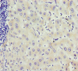 MCCC2 / MCCB Antibody - Immunohistochemistry of paraffin-embedded human liver cancer at dilution 1:100