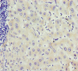MCCC2 / MCCB Antibody - Immunohistochemistry of paraffin-embedded human liver cancer at dilution 1:100