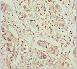 MCCC2 / MCCB Antibody - Immunohistochemistry of paraffin-embedded human pancreatic cancer at dilution 1:100