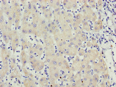 MCCC2 / MCCB Antibody - Immunohistochemistry of paraffin-embedded human liver cancer using MCCC2 Antibody at dilution of 1:100