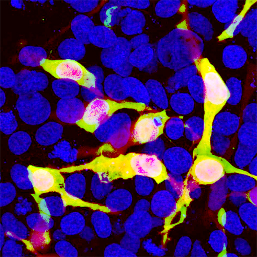 mCherry Antibody - HEK293 cells transfected in the same way and viewed in the confocal microscope. Most HEK293 cells are not transfected so only the nucleus of these cells can be visualized with a blue DNA stain. Cells which are transfected with mCherry are bright red. Staining with mCherry antibody is shown in Green. Green antibody staining is only seen cells which express Cherry, as expected, and the superimposition of the green and red results in an orange signal. Interestingly stronger Cherry staining is seen in the nucleus, possibly due to degradation of some Cherry molecules to release the low molecular weight Cherry fluorochrome.