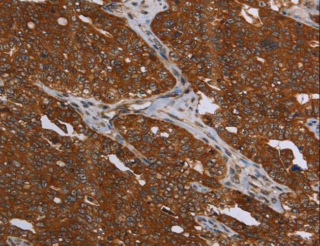 MCHR1 Antibody - Immunohistochemistry of paraffin-embedded Human ovarian cancer using MCHR1 Polyclonal Antibody at dilution of 1:30.