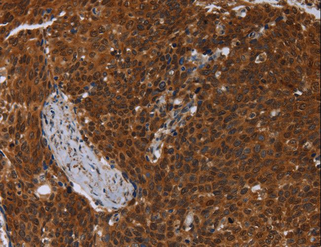 MCHR1 Antibody - Immunohistochemistry of paraffin-embedded Human cervical cancer using MCHR1 Polyclonal Antibody at dilution of 1:30.