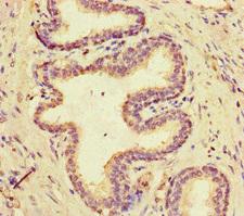 MCIDAS / MCIN Antibody - Immunohistochemistry of paraffin-embedded human prostate cancer at dilution of 1:100