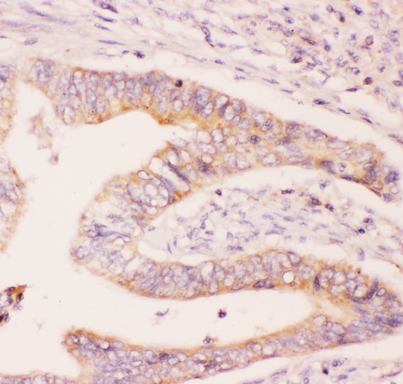 MCL1 / MCL 1 Antibody - MCL1 antibody IHC-paraffin: Human Intestinal Cancer Tissue.