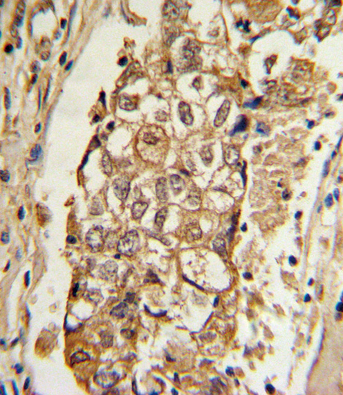MCL1 / MCL 1 Antibody - Formalin-fixed and paraffin-embedded human breast carcinoma with MCL1 Antibody (BH3 Domain Specific), which was peroxidase-conjugated to the secondary antibody, followed by DAB staining. This data demonstrates the use of this antibody for immunohistochemistry; clinical relevance has not been evaluated.