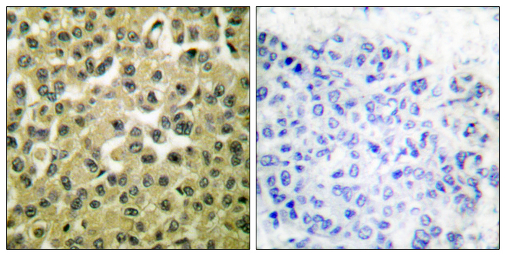 MCL1 / MCL 1 Antibody - Immunohistochemistry analysis of paraffin-embedded human breast carcinoma tissue, using MCL1 Antibody. The picture on the right is blocked with the synthesized peptide.