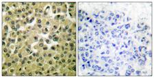 MCL1 / MCL 1 Antibody - Immunohistochemistry analysis of paraffin-embedded human breast carcinoma tissue, using MCL1 Antibody. The picture on the right is blocked with the synthesized peptide.