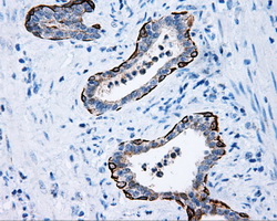 MCL1 / MCL 1 Antibody - IHC of paraffin-embedded Carcinoma of prostate tissue using anti-MCL1 mouse monoclonal antibody. (Dilution 1:50).