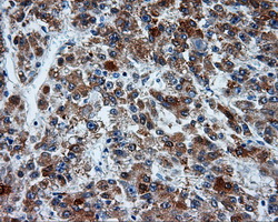 MCL1 / MCL 1 Antibody - IHC of paraffin-embedded Carcinoma of liver tissue using anti-MCL1 mouse monoclonal antibody. (Dilution 1:50).