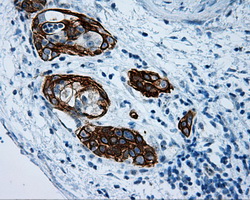 MCL1 / MCL 1 Antibody - IHC of paraffin-embedded Carcinoma of pancreas tissue using anti-MCL1 mouse monoclonal antibody. (Dilution 1:50).