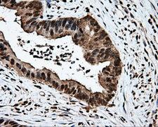 MCL1 / MCL 1 Antibody - IHC of paraffin-embedded Adenocarcinoma of colon tissue using anti-MCL1 mouse monoclonal antibody. (Dilution 1:50).