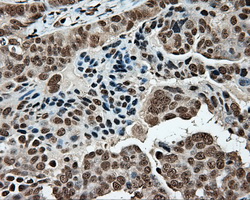 MCL1 / MCL 1 Antibody - IHC of paraffin-embedded Adenocarcinoma of ovary tissue using anti-MCL1 mouse monoclonal antibody. (Dilution 1:50).