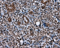 MCL1 / MCL 1 Antibody - IHC of paraffin-embedded Carcinoma of thyroid tissue using anti-MCL1 mouse monoclonal antibody. (Dilution 1:50).