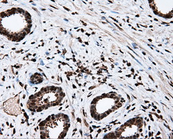 MCL1 / MCL 1 Antibody - IHC of paraffin-embedded Carcinoma of prostate tissue using anti-MCL1 mouse monoclonal antibody. (Dilution 1:50).